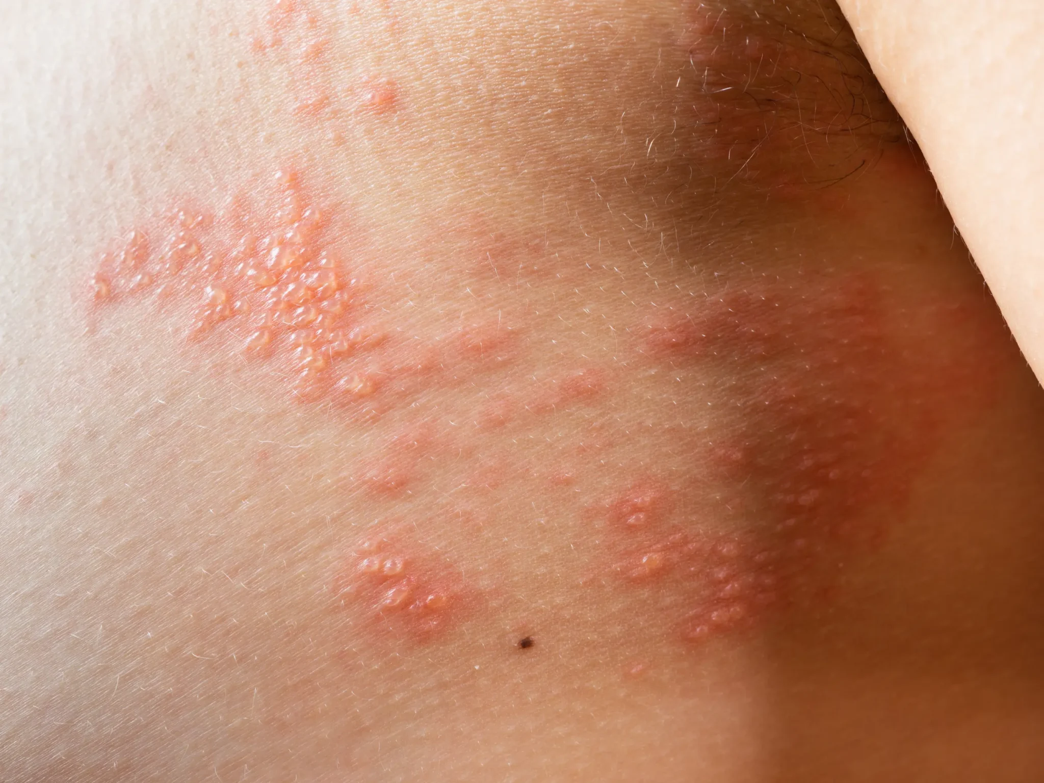 dermatiti ed eruzioni cutanee, i sintomi dell'allergia all'istamina