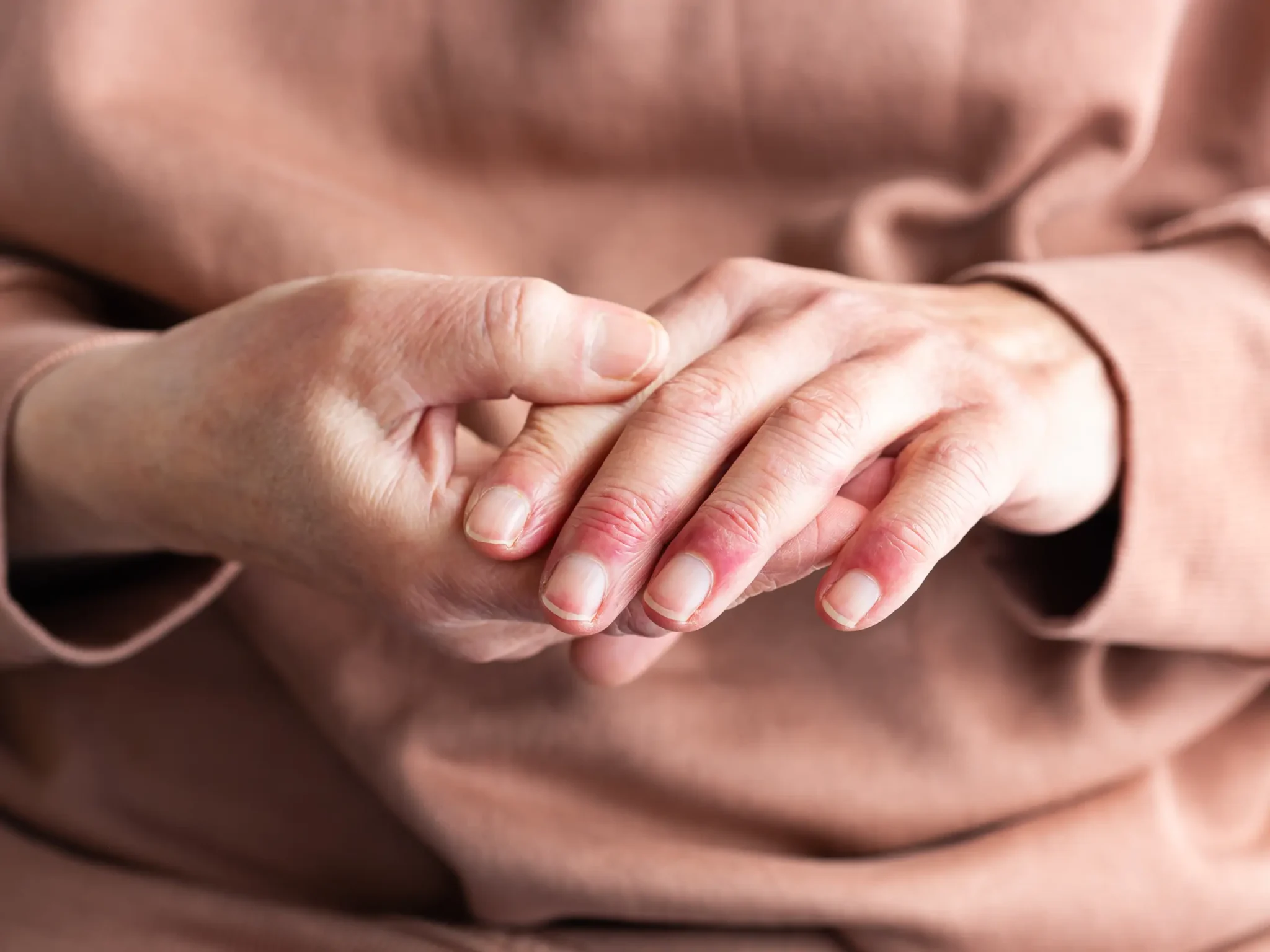 mani affette da dermatite, uno dei sintomi dell'intolleranza al nichel e dell'allergia al nichel
