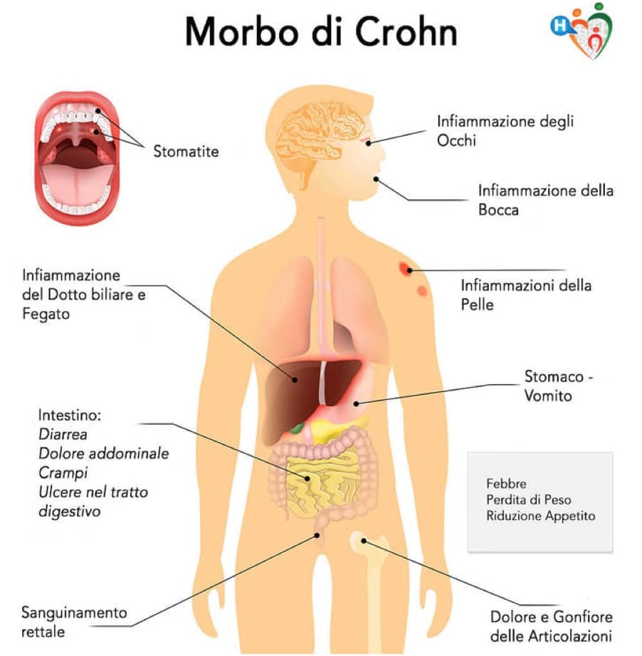 Schema riassuntivo morbo di chron