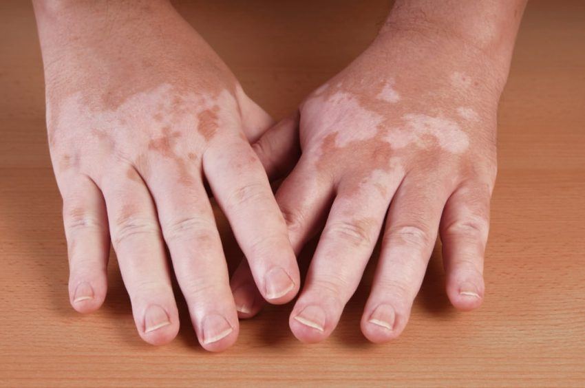 Patologie autoimmuni e vitiligine Alimentazione in caso di patologie autoimmuni