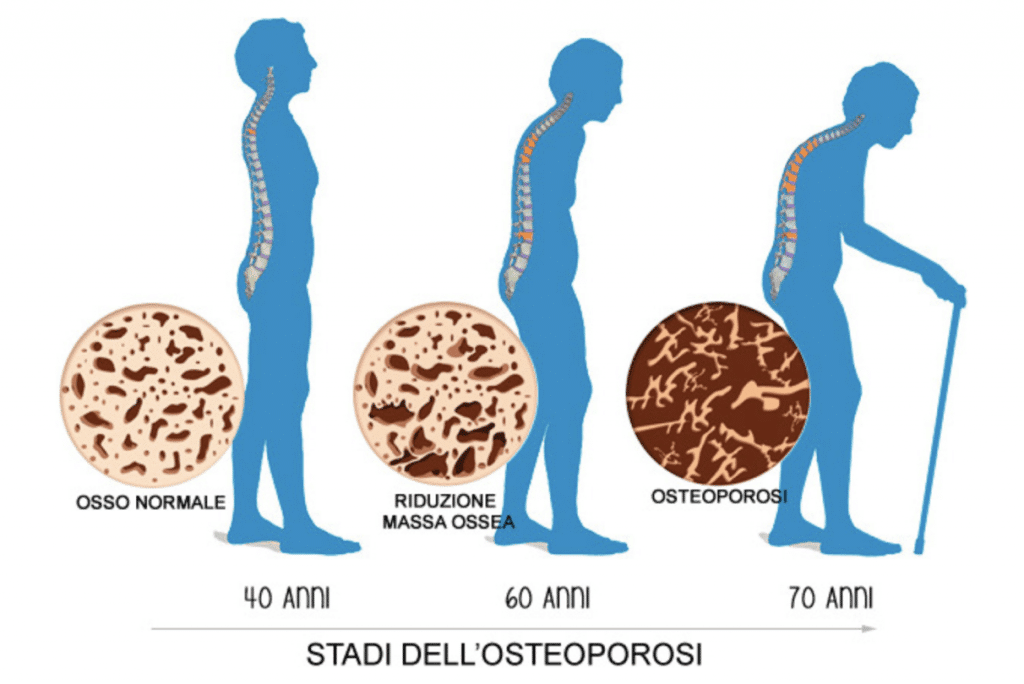Schermata 2021 08 16 alle 14.01.40 Osteoporosi, cosa c'è da sapere!