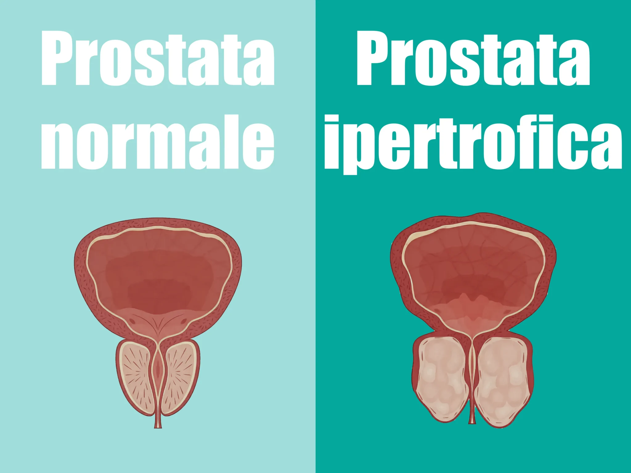 Ipertrofia prostatica paragonata a prostata normale