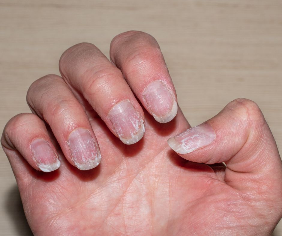 Alimentazione per unghie sane e forti in caso di fragilità e desquamazione